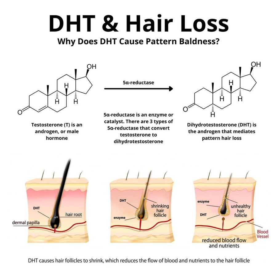 DHT and hair loss diagram