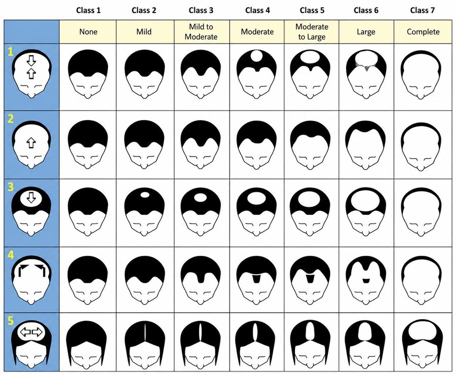 Norwood and Ludwig hair-loss scale