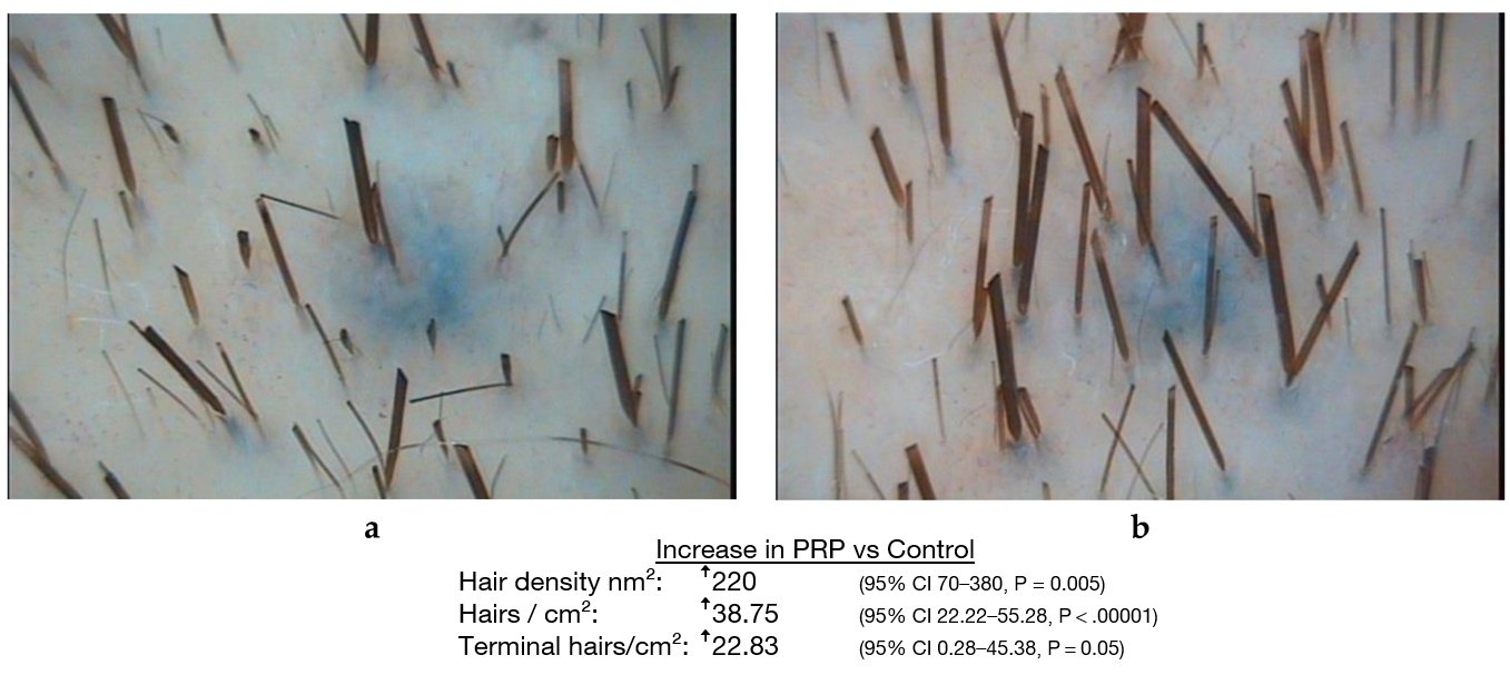PRP vs Control — clinical study micrographs showing increased hair density and shaft count after PRP treatment.